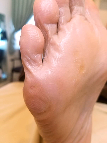 元看護師が施術 魚の目 タコ かかとの角質 足のお悩みを解決して ネイル映えする足 に Preko