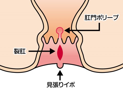 Vol 30 裂肛 切れ痔 について Preko